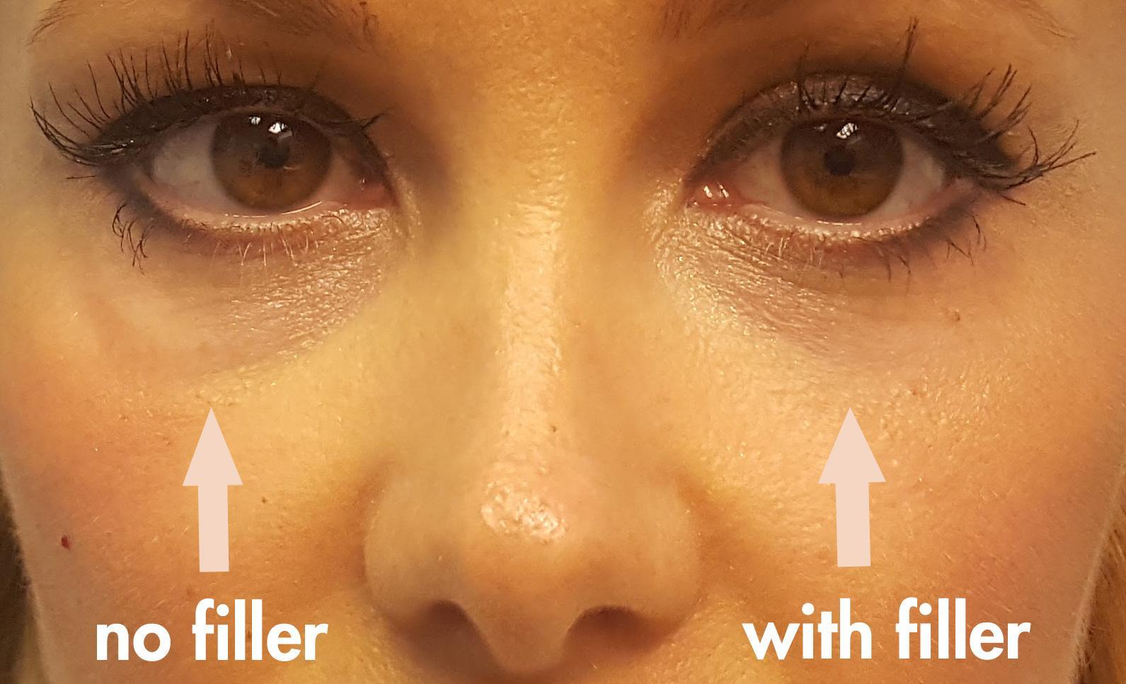 3 Ways To Reduce Puffy Red Eyes In The Morning | UseMyPro.com